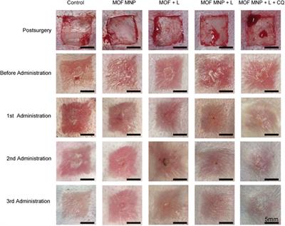 Visible light-driven photodynamic therapy for hypertrophic scars with MOF armored microneedles patch